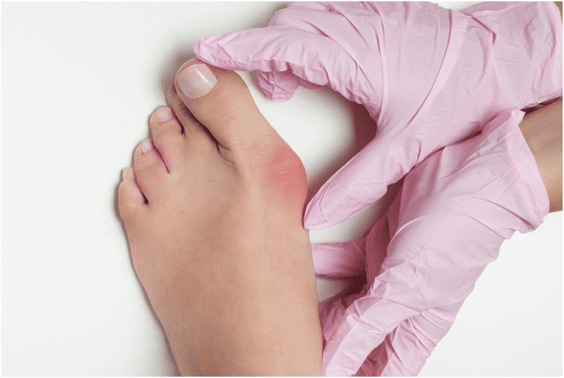 What is a Bunion?
