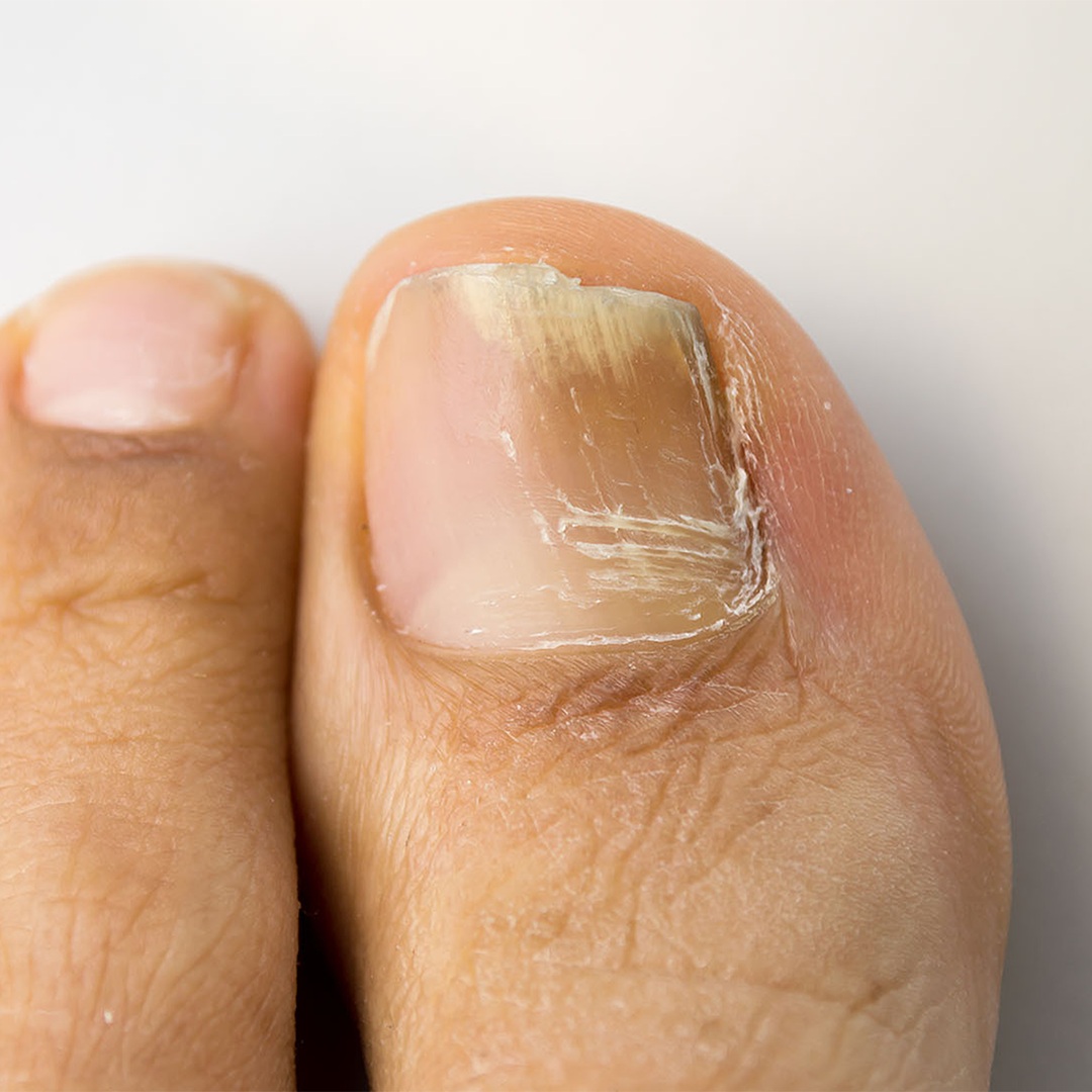What is Nail Fungus?