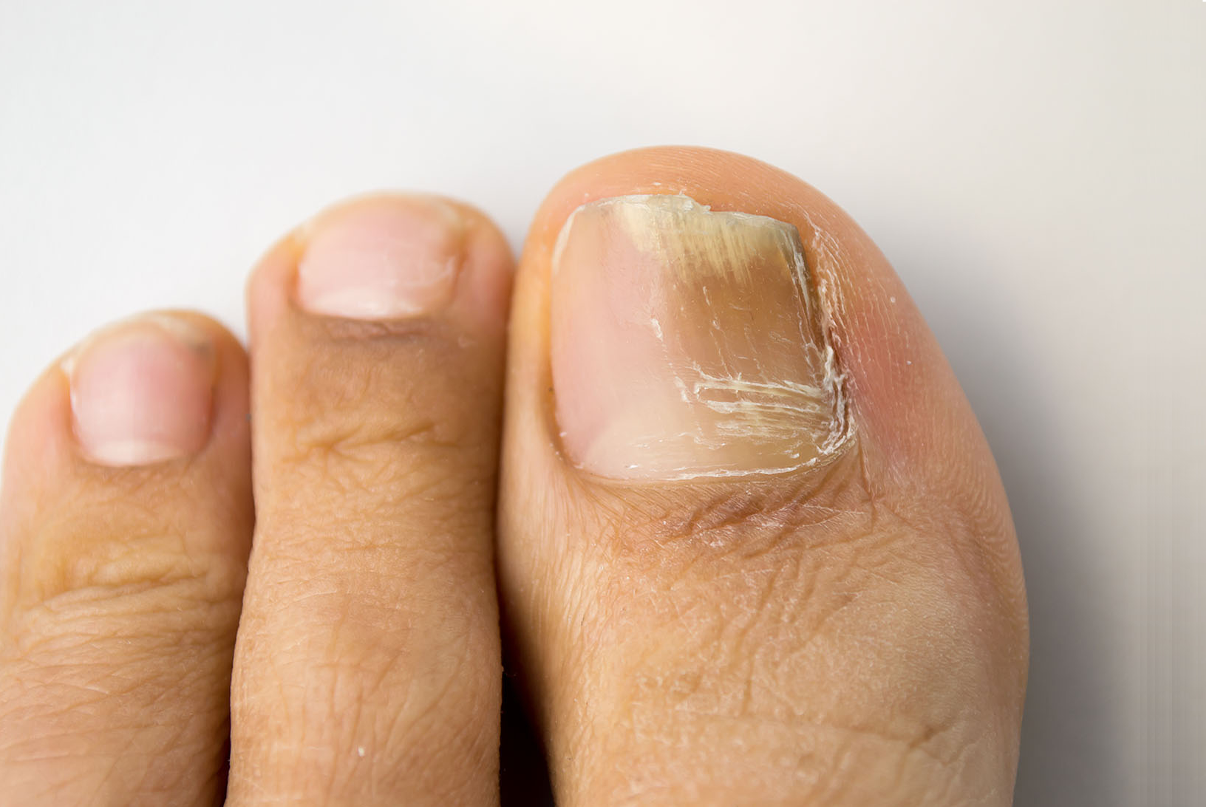 Athlete’s Foot / Fungal Skin Infection