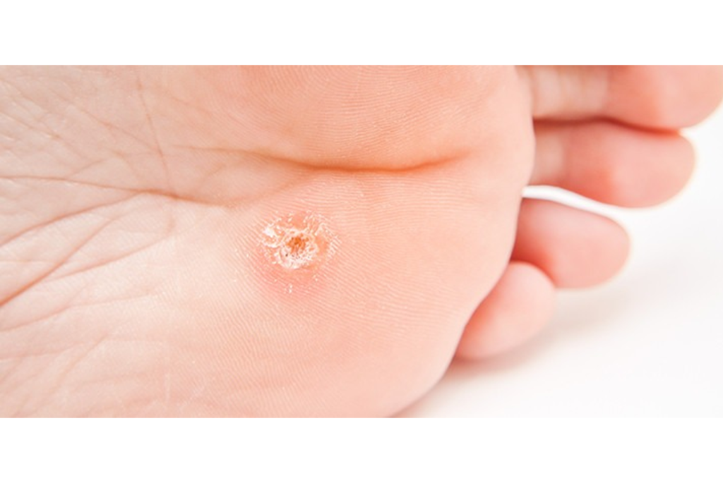 Wart Removal in Singapore | Skin Wart Treatment Clinic