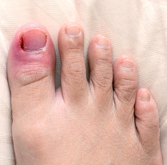 Ingrown Toenails Treatment | Mississauga | Foot Specialists