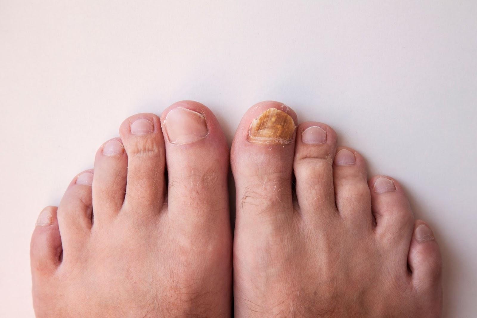 What is nail fungus?
