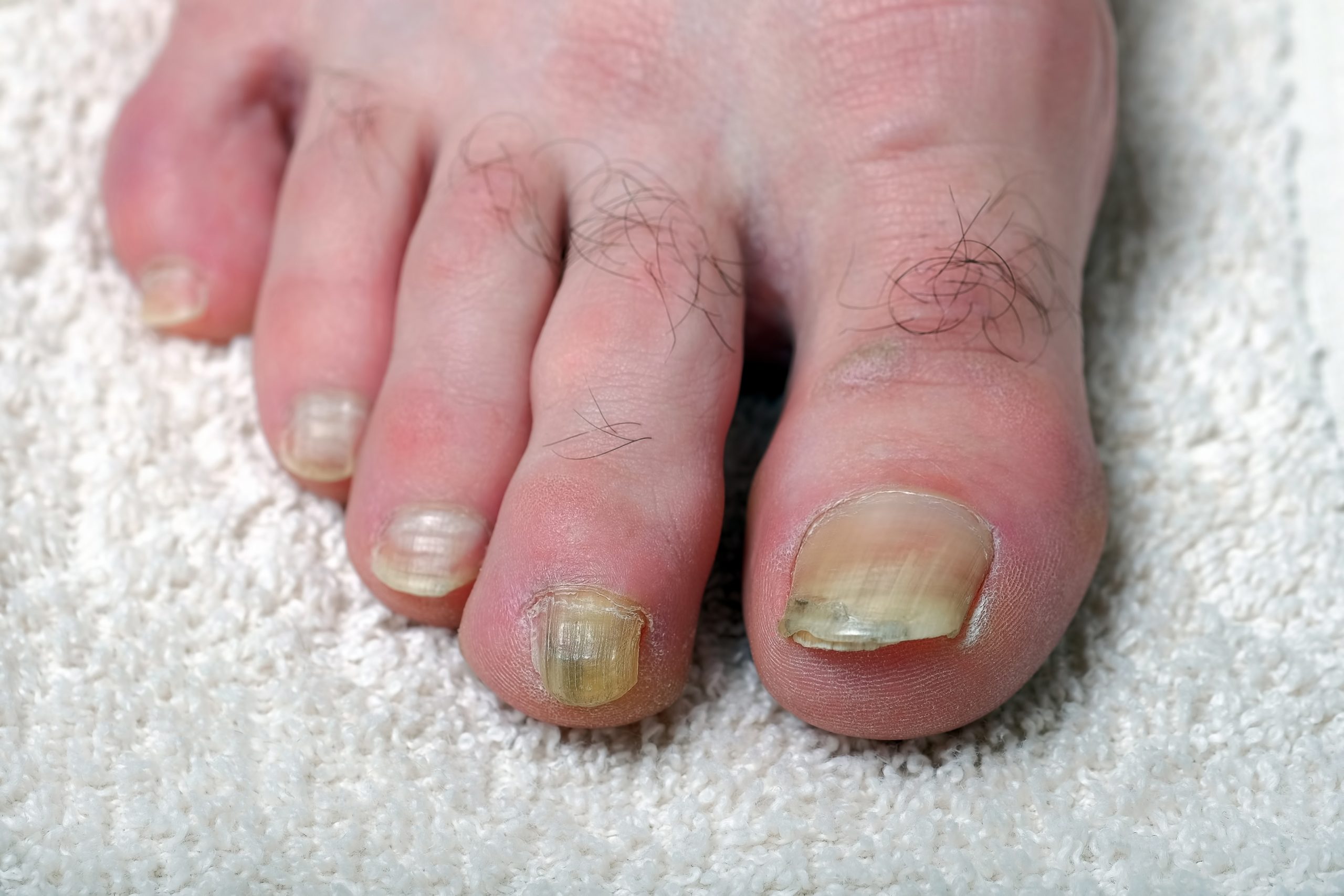 What are thickened toenails?