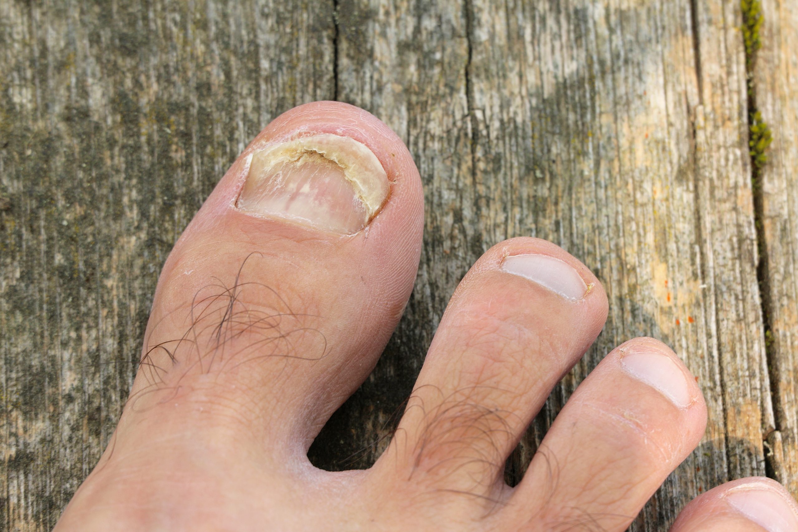 Damaged Toenails 