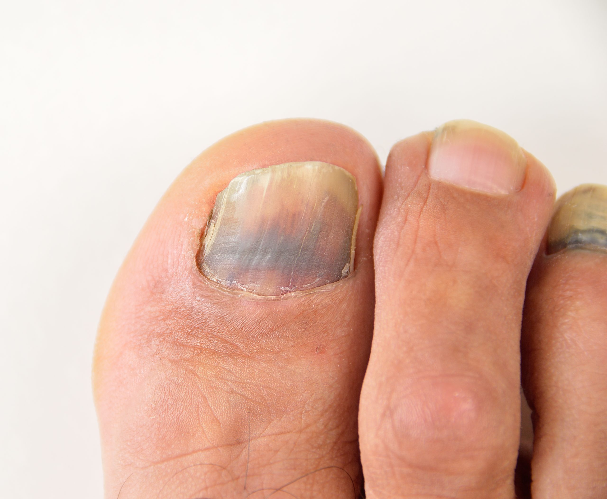 What are discoloured toenails?