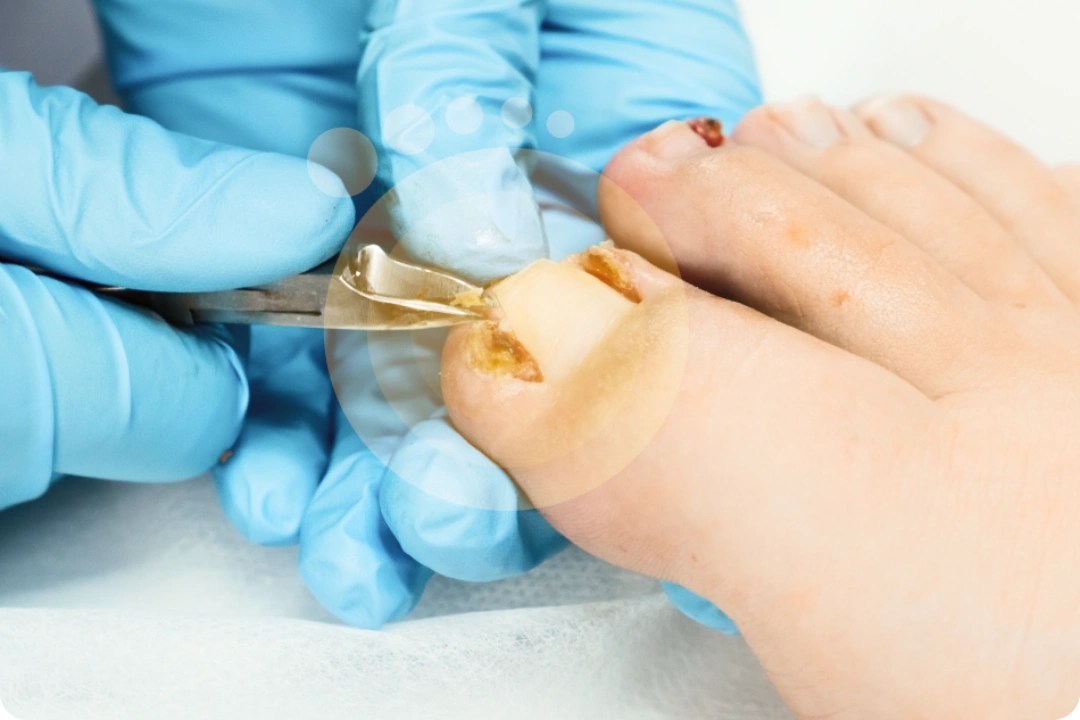 Slant Back Cut for Ingrown Toenails Singapore