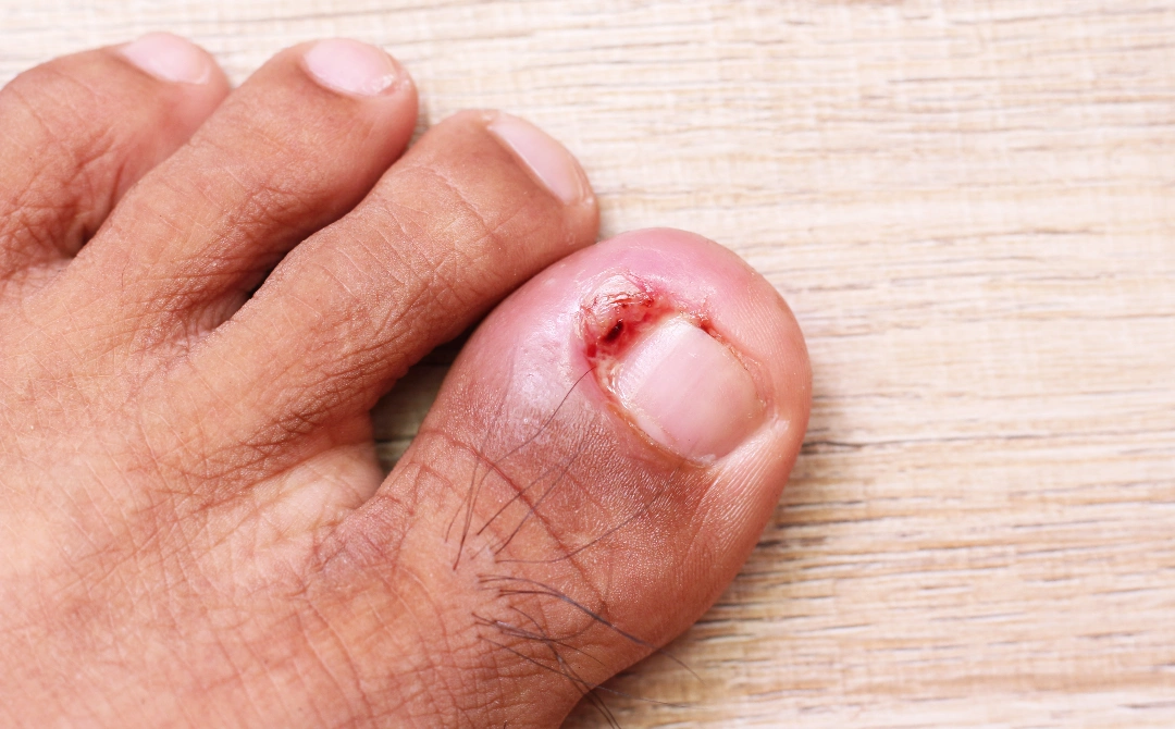 Treatment for Ingrown Nails Singapore