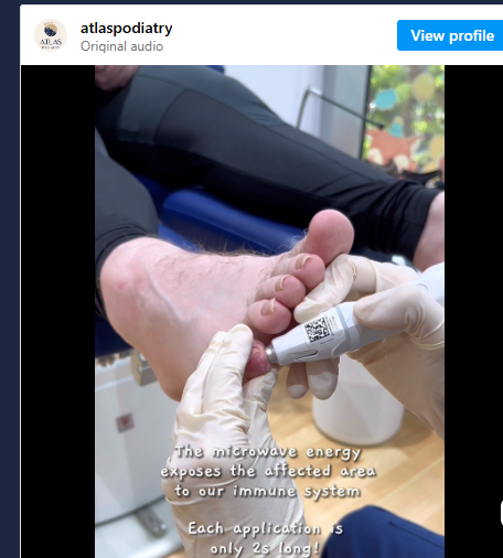 Swift® Microwave Therapy for Wart Removal in Singapore 