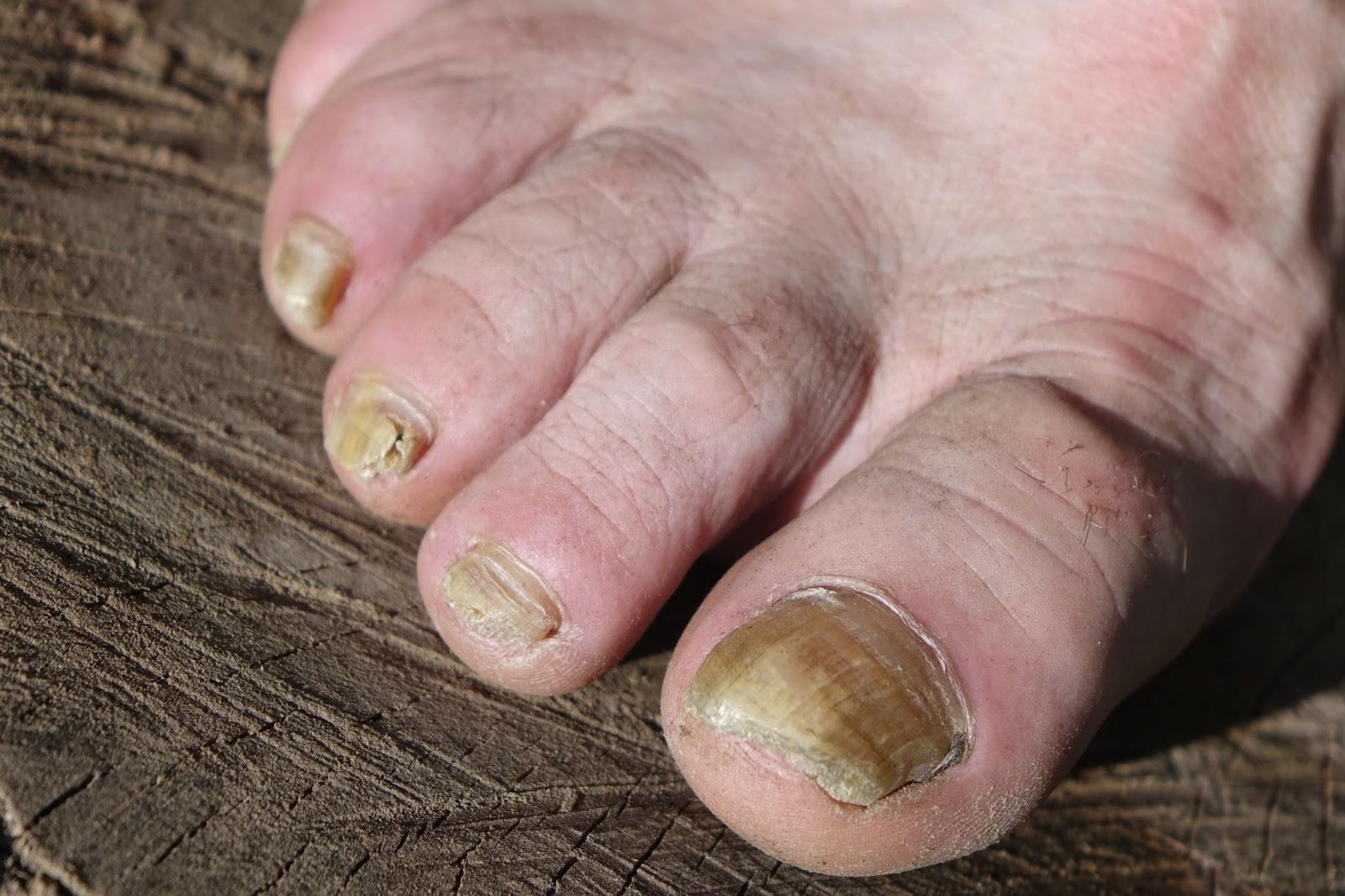 Fungal Toenail Treatment in Singapore