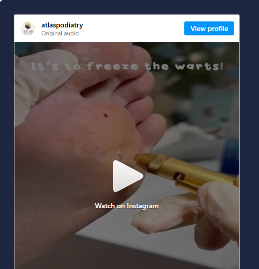 Cryotherapy for Wart Removal in Singapore 