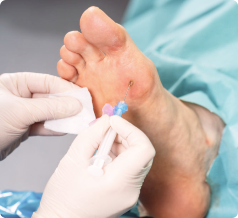 Wart Removal in Singapore