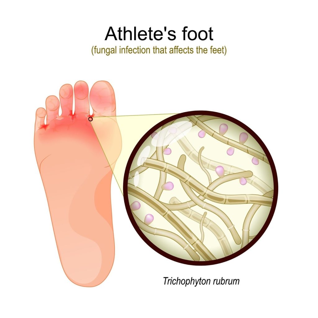Causes of Athlete's Foot Singapore