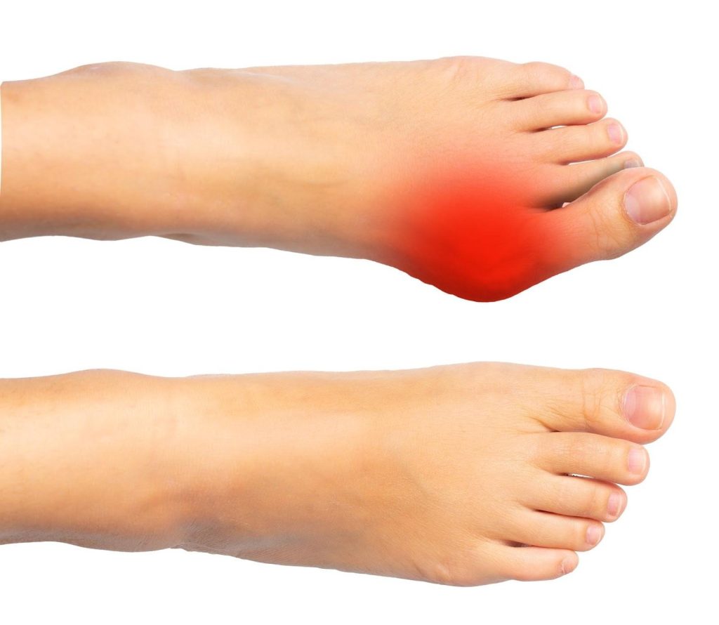 Symptoms of Bunion Singapore