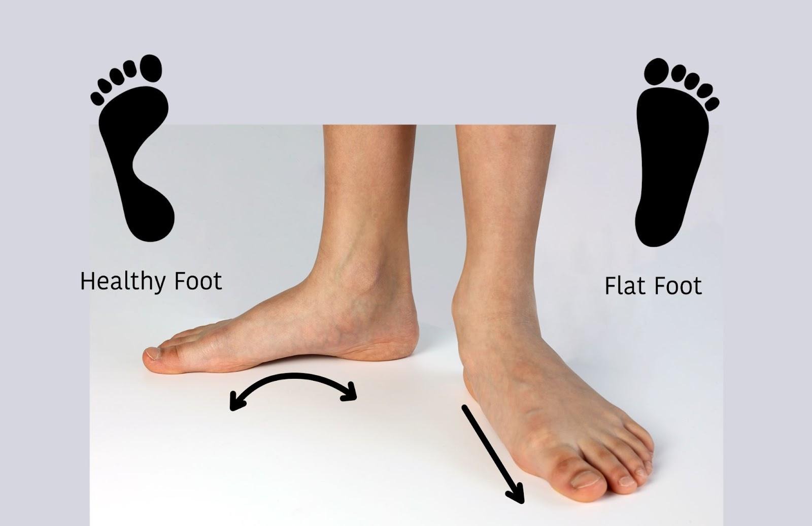 What are flat feet?