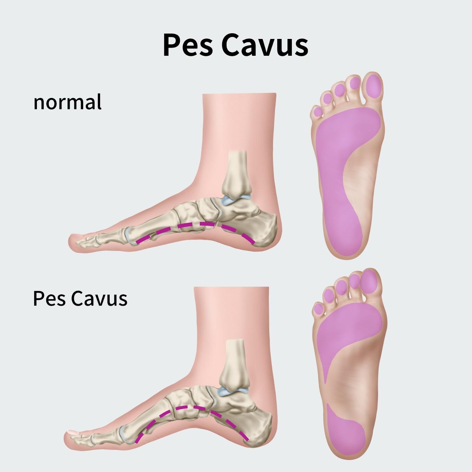 What are high arch feet (Pes Cavus)?