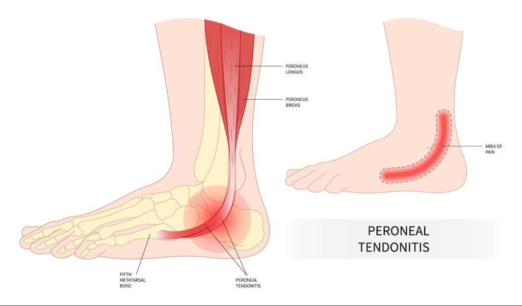 Peroneal Tendinopathy Singapore