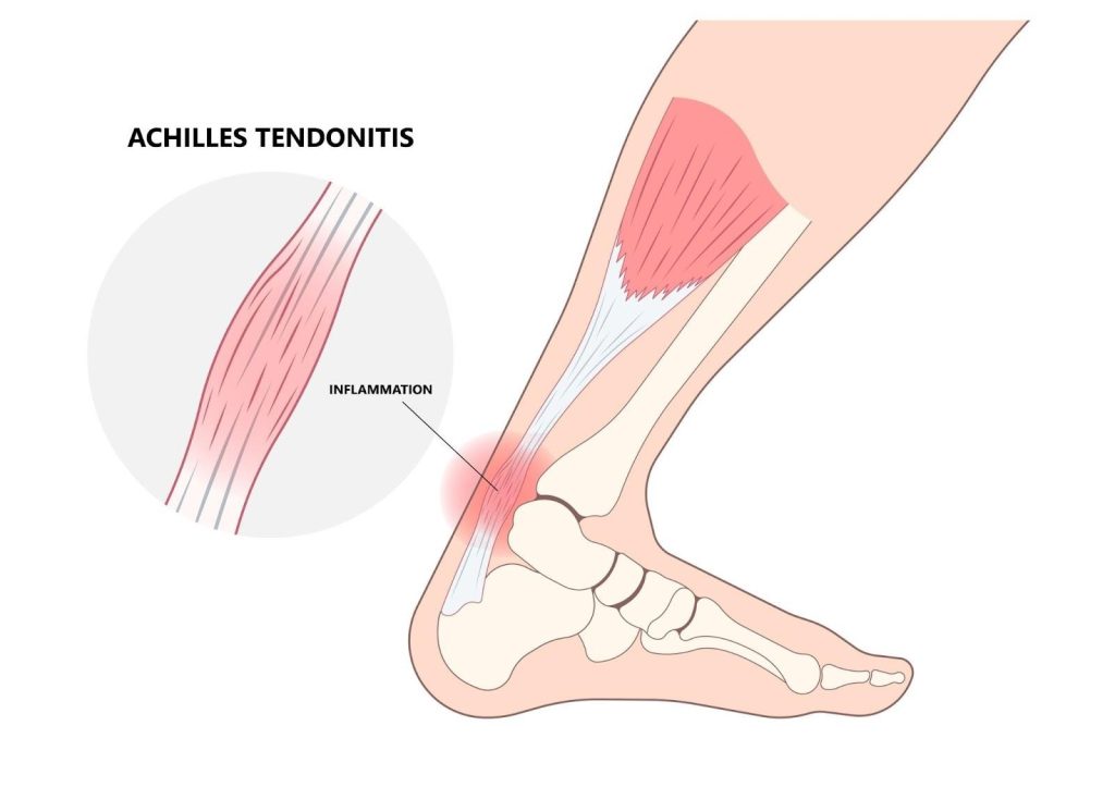Achilles Tendinopathy Singapore