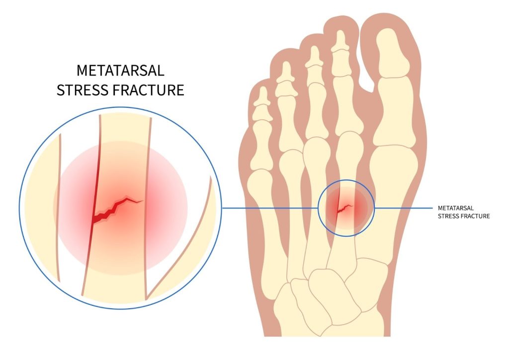 Metatarsal Stress Fracture Singapore