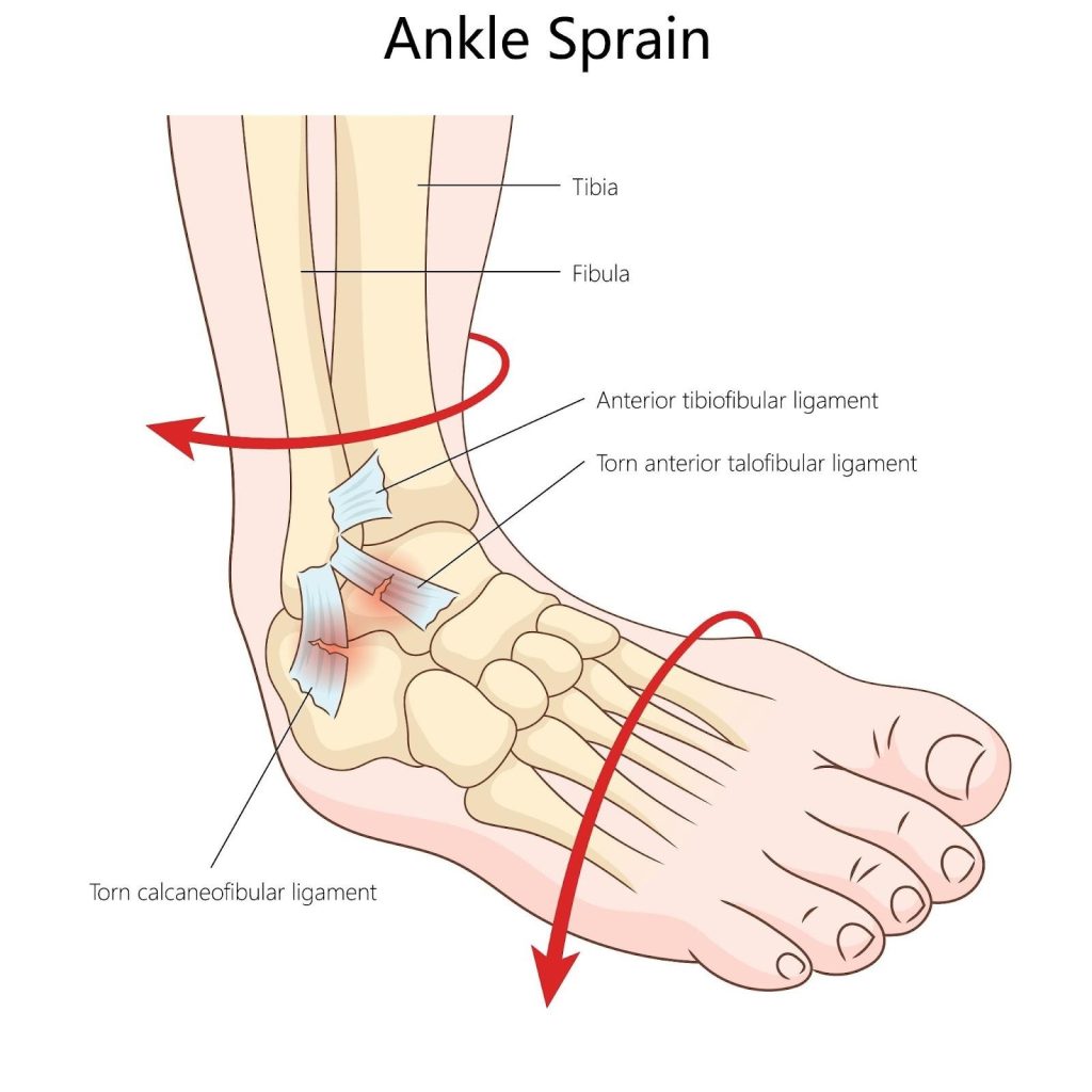 Ankle Sprain Singapore