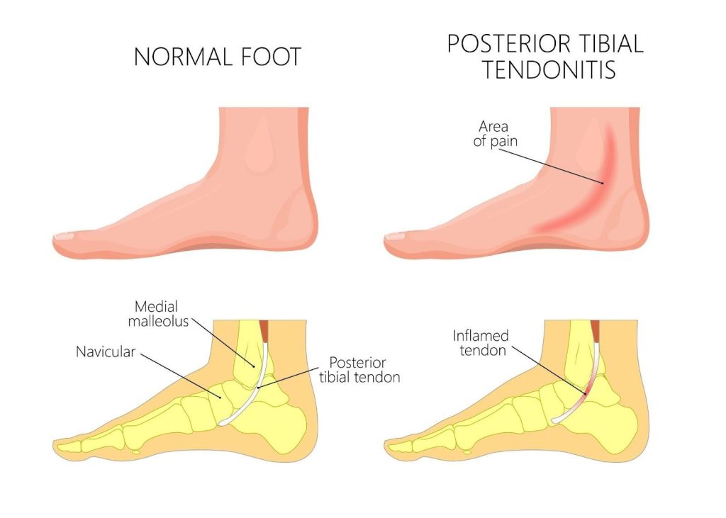 Tibial Tendinopathy Singapore